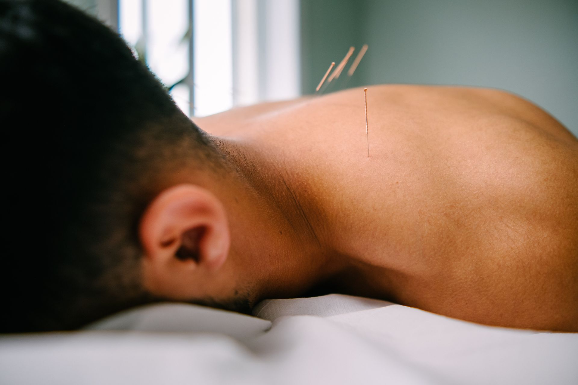 Acupuncture for Anxiety