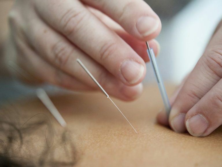 A hand inserting acupuncture needles into skin.
